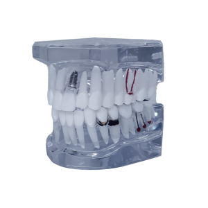 MANEQUIM COM ENDODONTIA E IMPLANTES - cód. 13854